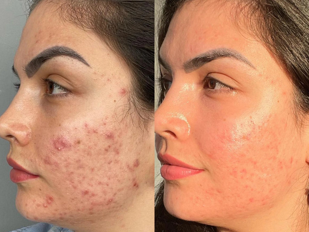 5 Differences between A Chemical Peel and A Herbal Peel.